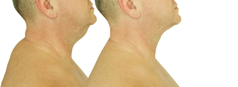 Před a po léčbě vdovského hrbu