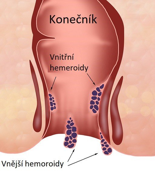 Ilustrace konečníku s vnitřními a vnějšími hemeroidy