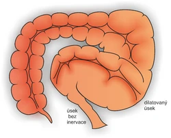 Anatomie střeva s označeným úsekiem bez inervace