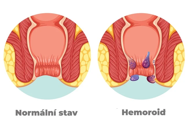 Porovnání normálního stavu a hemoroidů v análním kanálu