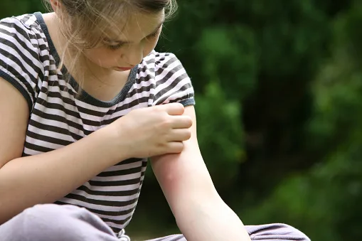 Dívka dráždí místo bodnutí hmyzem na svém paži.