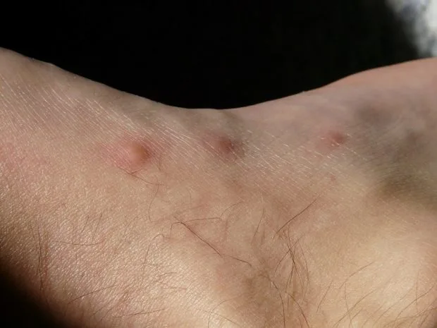 Kousnutí štěnice na lidské kůži s několika červenými pupínky.