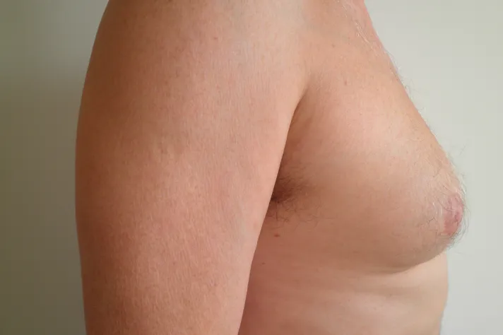 Strana těla muže s gynekomastií pro článek o léčbě.