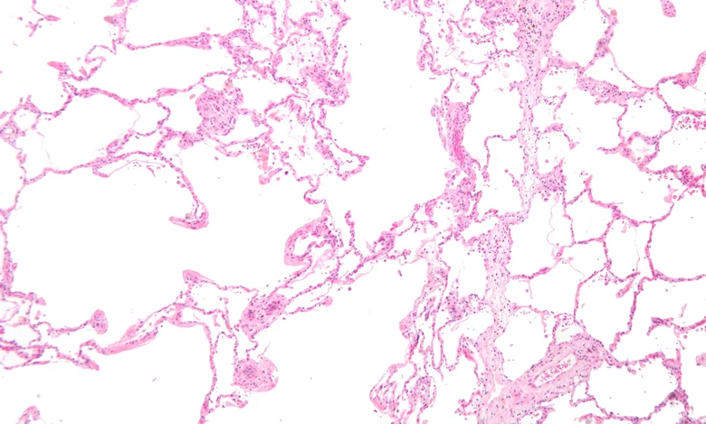 Lung tissue emphysema