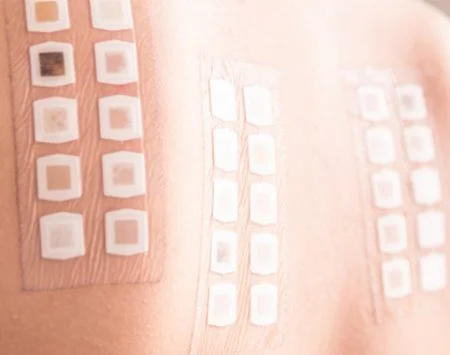 Alergické testovací náplasti na kůži při kožním testu.