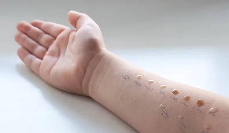Kožní kožní alergický test s kapkami na předloktí.