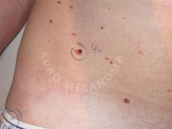 Značené znaménko na kůži pro vyšetření melanomu.