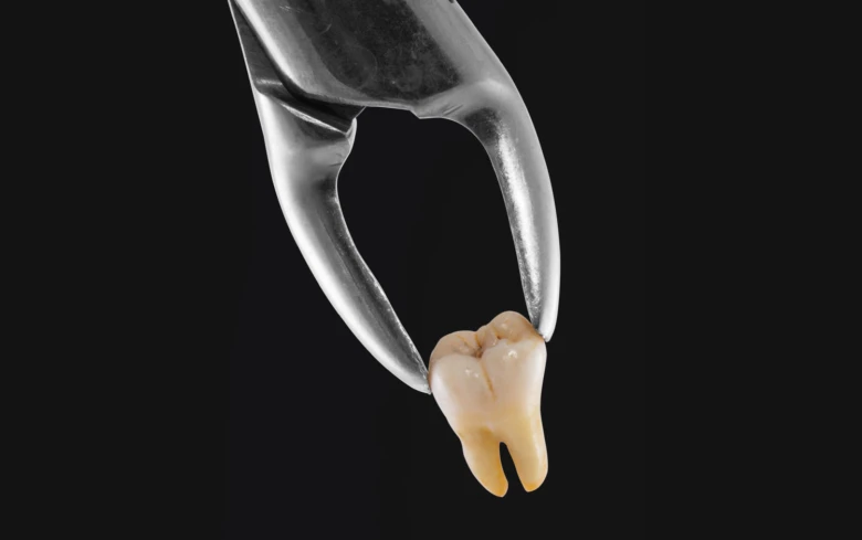 Vytržený zub moudrosti držený v dentálním pinceti.