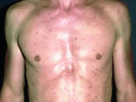 Muž s vyrážkou na hrudi jako možný HIV symptom.