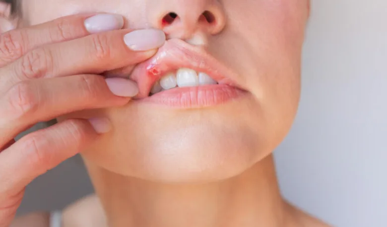 Mouth with canker sore