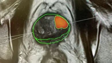 Magnetická rezonance prostaty s označenou oblastí nádoru.