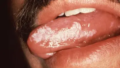 Bílá skvrna na jazyku jako příznak infekce při AIDS.