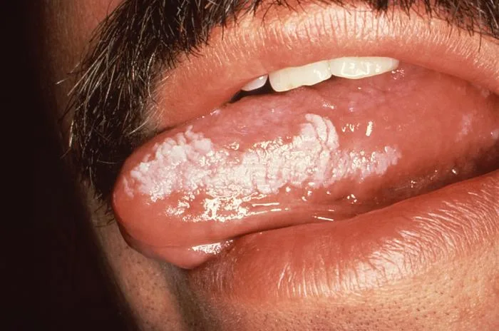 Bílá skvrna na jazyku jako příznak infekce při AIDS.