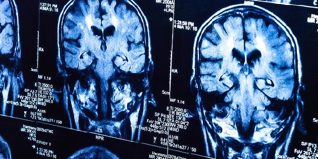 MRI snímky mozku pro diagnostiku nádorů