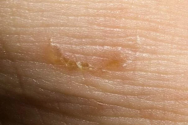 Zvětšený pohled na kůži s typickým svrabem a jasně viditelným tunelem.