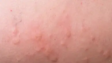 Vyrážka na kůži s červenými pupínky.