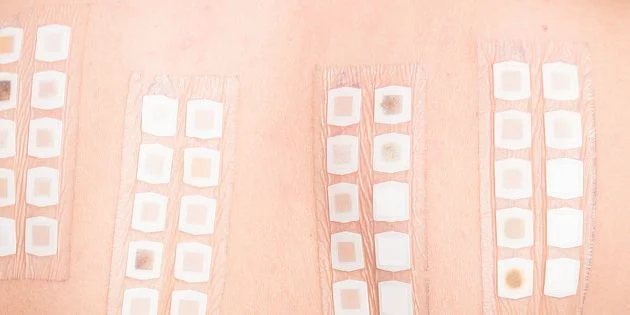 Kůže s alergickými testovacími pláštiky pro diagnostiku reakcí.