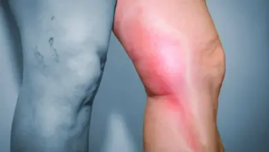Porovnání zdravé nohy s zčervenalou a zanícenou kůží kolem kolena.