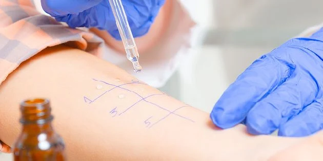 Kožní kožní test pro diagnostiku alergie na léky