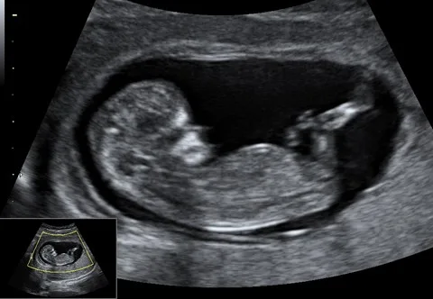 Ultrazvukový snímek plodu v 12. týdnu těhotenství.