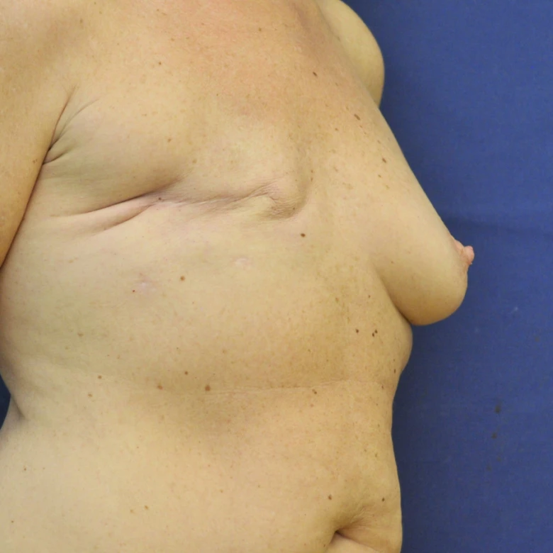 Breast reconstruction patient side view