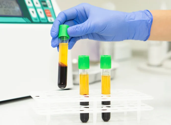 Ruce v rukavicích drží zkumavku s krví pro analýzu hemostázy.